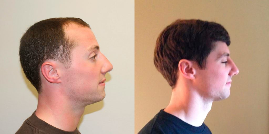 Young Man Flies In From California To Have A MaxHarvest™ Hair Transplant Before And Afters Hairline 