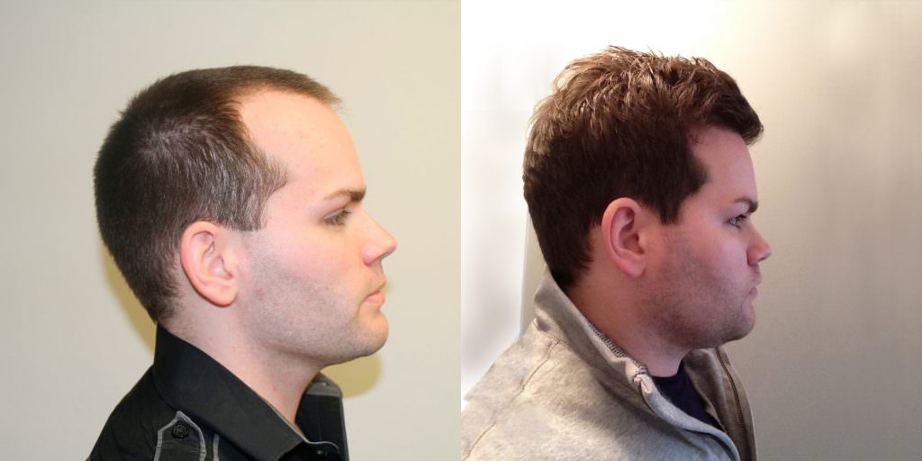 Premature Hair Loss Correction Before And Afters Crown Hairline Healing/Growth Process