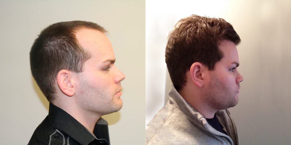 Premature Hair Loss Correction Before And Afters Crown Hairline Healing/Growth Process 