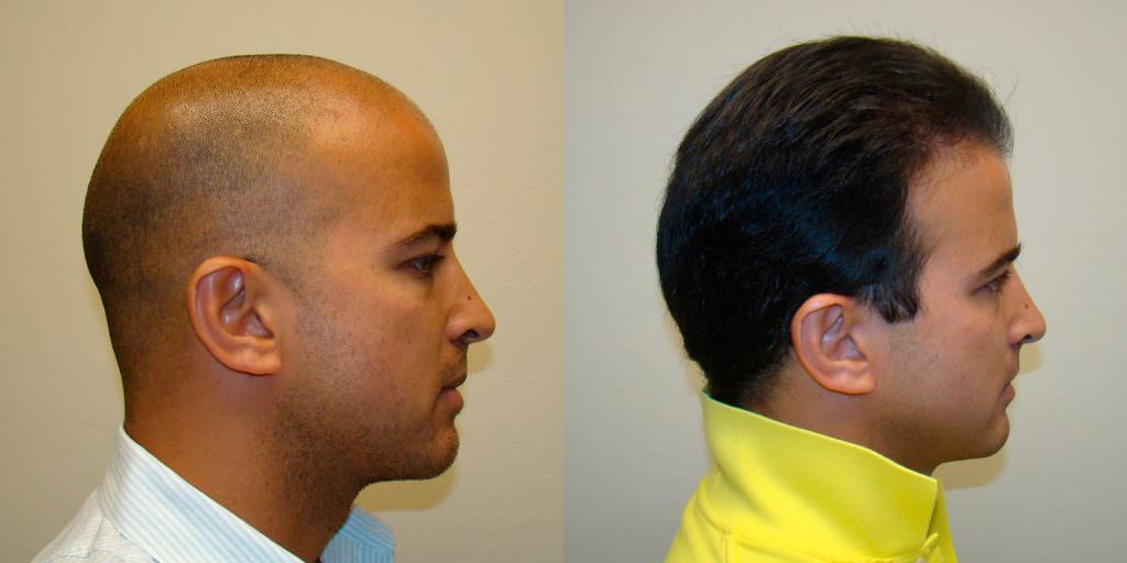 Aldo's Ridiculous 5 Month Transformation - World Famous Hair Transplant Results Before And Afters Crown Difficult Cases Hairline Healing/Growth Process 