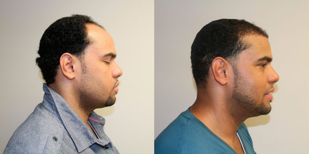 5 Month Complete Hairline Restoration Results Before And Afters Hairline Healing/Growth Process Suture Line/Scar 