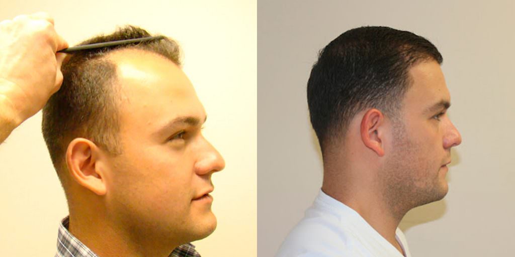 Worried About A Scar After A Hair Transplant? Before And Afters Hairline Suture Line/Scar 