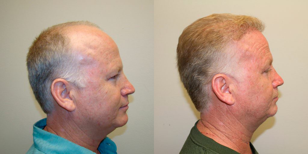 Complete Hair Loss Transformation After Just 1 MaxHarvest Plus™ Procedure Before And Afters Crown Difficult Cases Hairline Healing/Growth Process MaxHarvest Plus™ Procedures