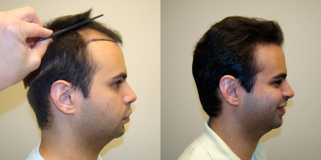 Young Man's Hairline and Crown Restoration Before And Afters Crown Hairline 