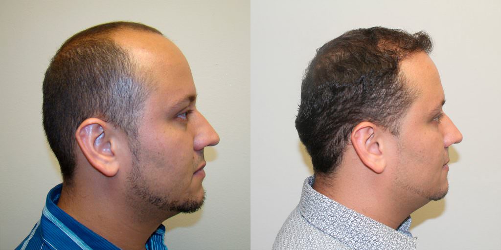 Another Great Hair Transplant Result To Fix Premature Balding Before And Afters Hairline