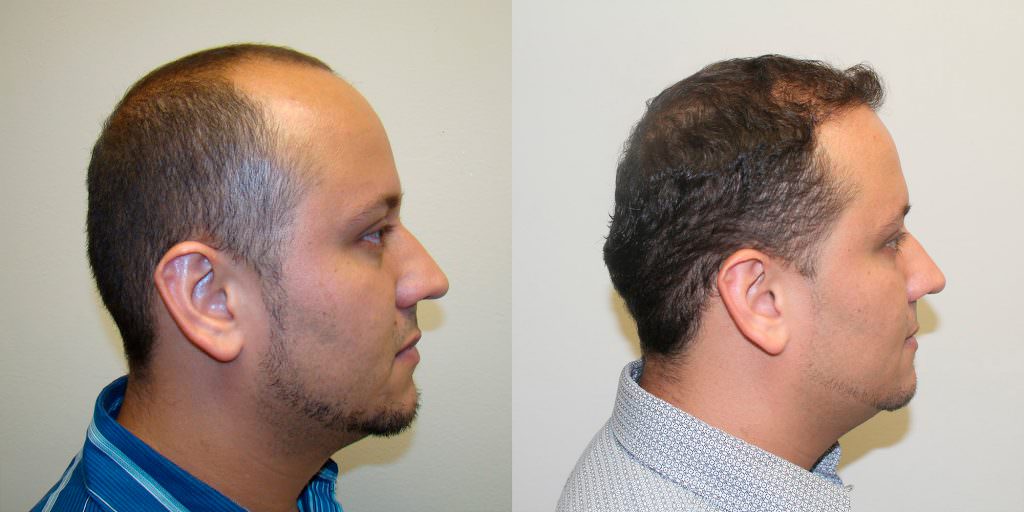 Another Great Hair Transplant Result To Fix Premature Balding Before And Afters Hairline 