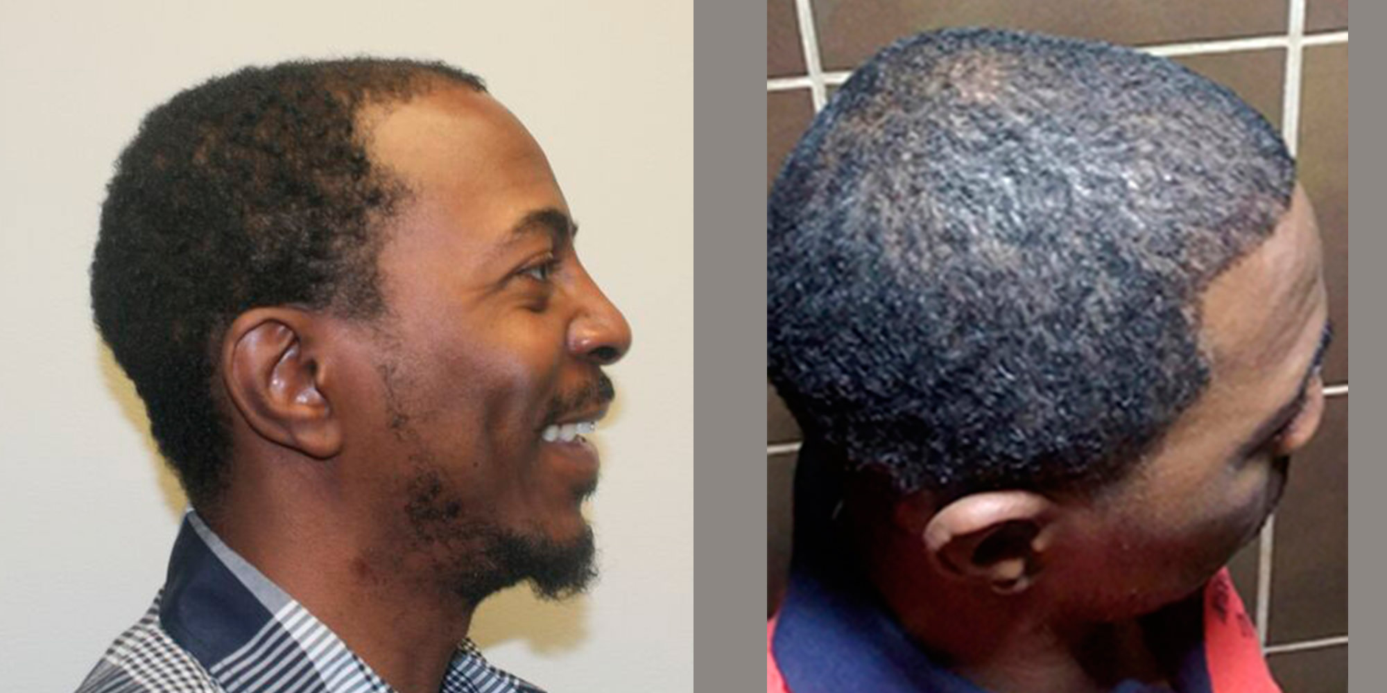 How Much Hair Transplant Cost.