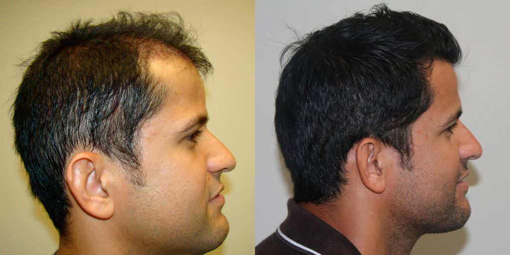 Full And Thick Density, 1 Procedure Hair Transplant Result Before And Afters Crown Healing/Growth Process 