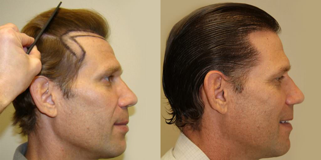 Dr. Bolton's Own Patient Advisor Gets A MaxHarvest™ Hair Transplant Before And Afters Hairline Healing/Growth Process Testimonials 