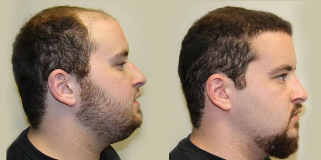 19 Year Old's Completely Restored Look After Hair Transplant Before And Afters Crown Difficult Cases Hairline Testimonials 