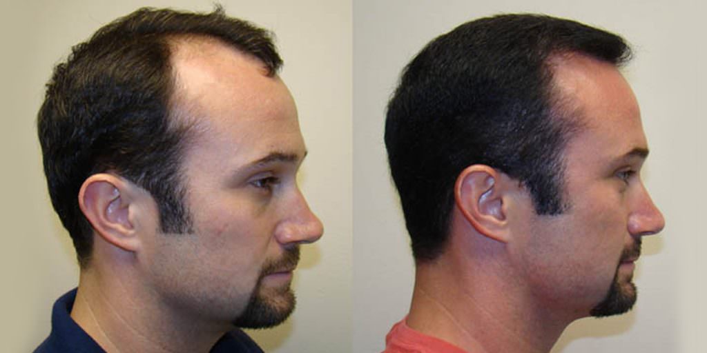 How To Reverse Balding In One MaxHarvest™ Procedure Before And Afters Hairline Testimonials 