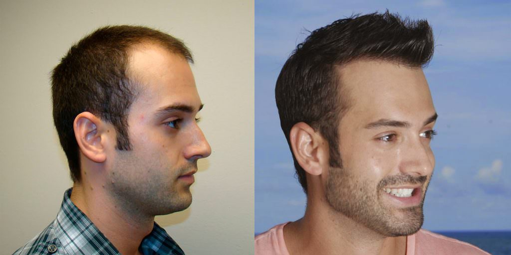 Ryan's Full Hair Transplant Journal Healing/Growth Process Testimonials 