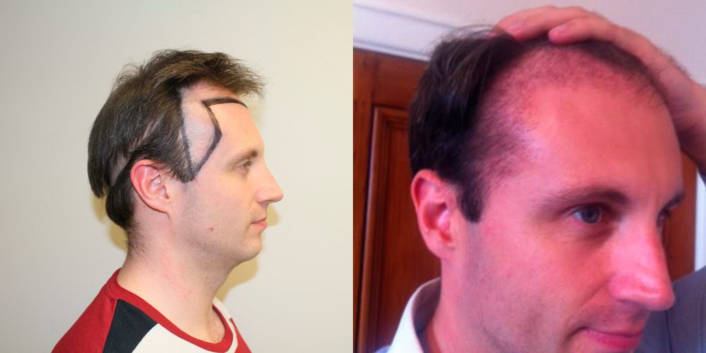 Frame Your Face With A Professional Hair Transplant Before And Afters Hairline Healing/Growth Process MaxHarvest Plus™ Procedures 