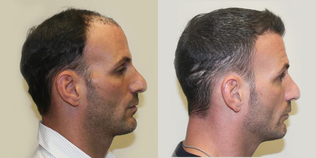 Extreme Hair Loss Is Not The Only Option Before And Afters Crown Hairline 