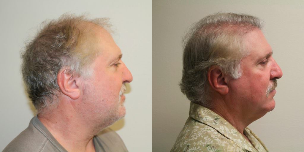 Hair Transplant Before And After Importance Before And Afters Crown Difficult Cases Healing/Growth Process 