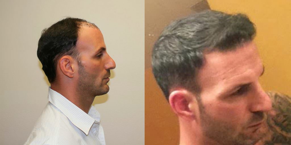 Extreme Hair Loss Is Not The Only Option Before And Afters Crown Hairline 