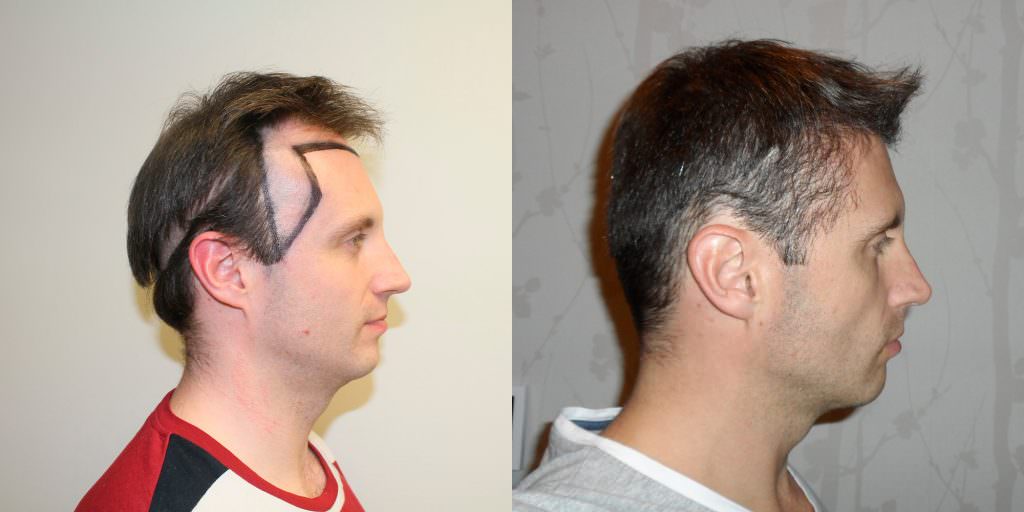 Frame Your Face With A Professional Hair Transplant Before And Afters Hairline Healing/Growth Process MaxHarvest Plus™ Procedures 