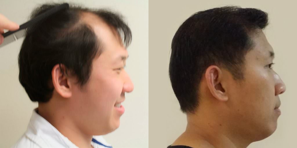 Napalese Patient's MaxHarvest Plus™ Hair Transplant Results At Halfway Point Before And Afters Crown Difficult Cases Hairline Healing/Growth Process MaxHarvest Plus™ Procedures 