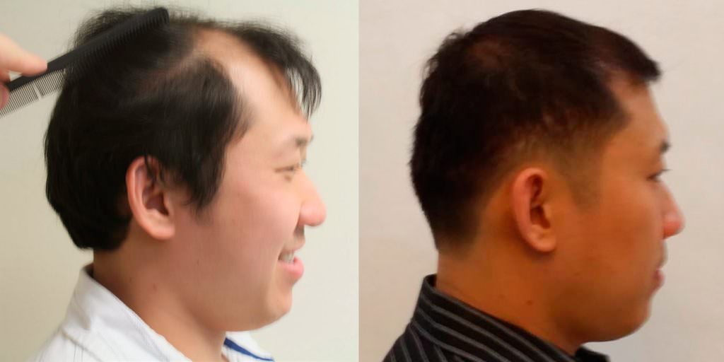 Napalese Patient's MaxHarvest Plus™ Hair Transplant Results At Halfway Point Before And Afters Crown Difficult Cases Hairline Healing/Growth Process MaxHarvest Plus™ Procedures