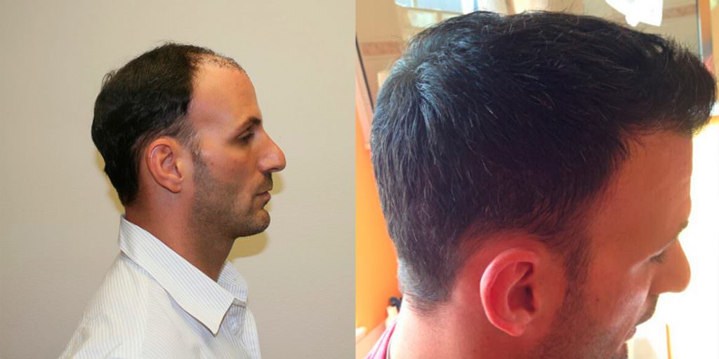 Extreme Hair Loss Is Not The Only Option Before And Afters Crown Hairline 