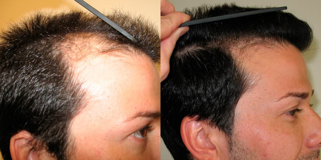 5 Years After Hair Transplant Follow-Up Before And Afters Hairline Healing/Growth Process 