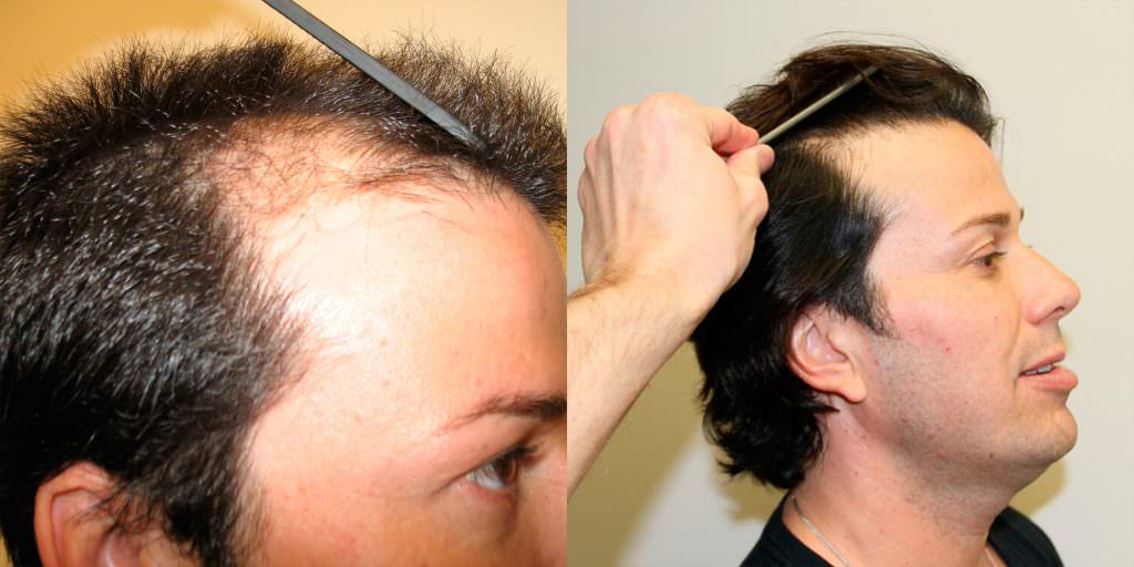 5 Years After Hair Transplant Follow-Up Before And Afters Hairline Healing/Growth Process 