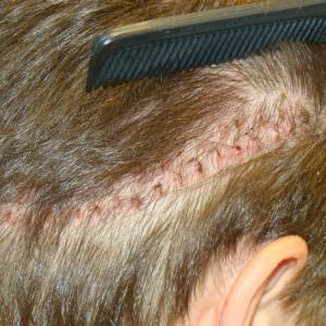 Corrective Hair Restoration With Previous Scar Removal Before And Afters Hairline Healing/Growth Process Suture Line/Scar 