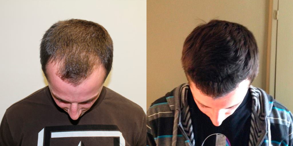 Young Man Flies In From California To Have A MaxHarvest™ Hair Transplant Before And Afters Hairline 