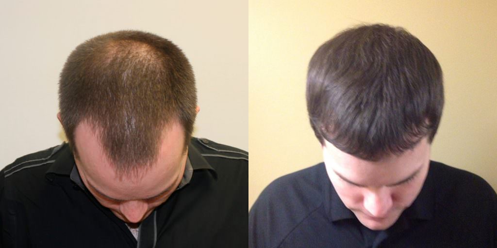 Premature Hair Loss Correction Before And Afters Crown Hairline Healing/Growth Process 