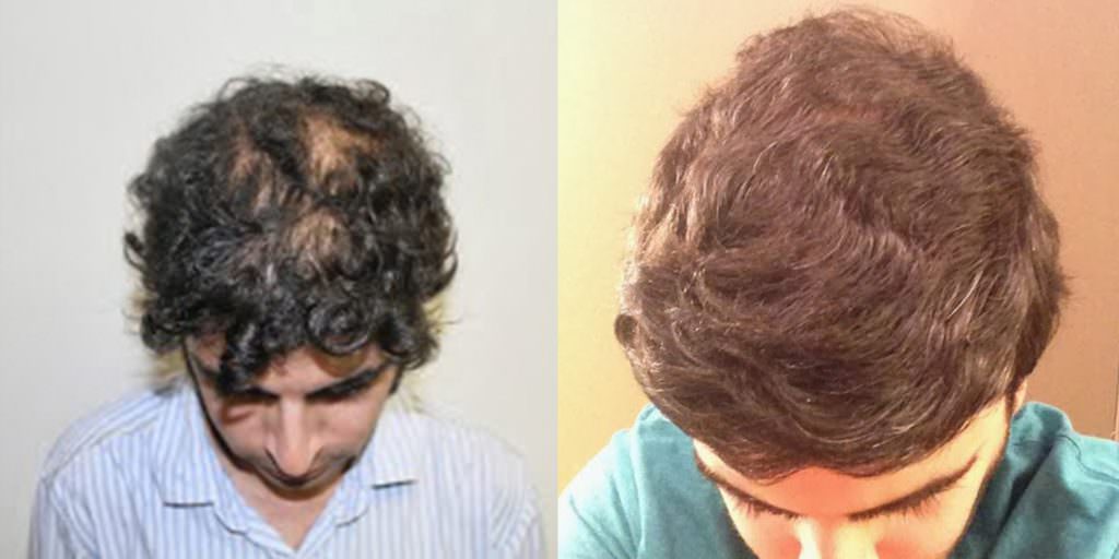 David's Testimonial - Increased Confidence After Hair Transplant Before And Afters Testimonials 