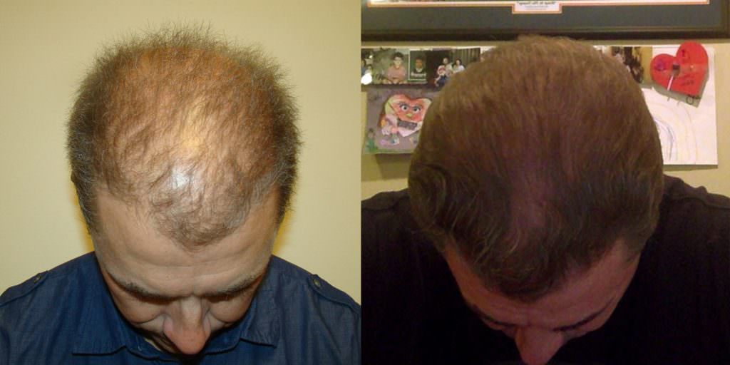 Density Improvement Across Entire Head With MaxHarvest Plus™ Hair Transplant Before And Afters Crown Difficult Cases MaxHarvest Plus™ Procedures 