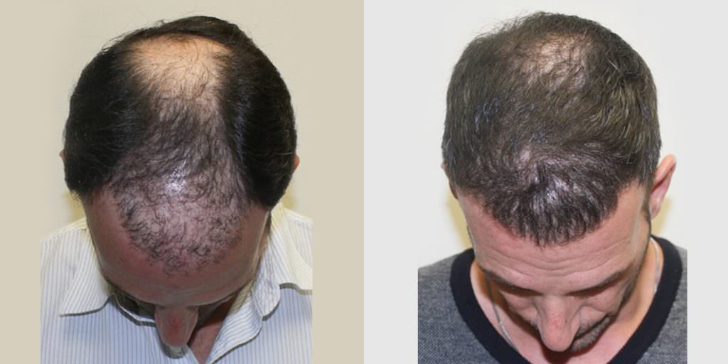 Extreme Hair Loss Is Not The Only Option Before And Afters Crown Hairline 