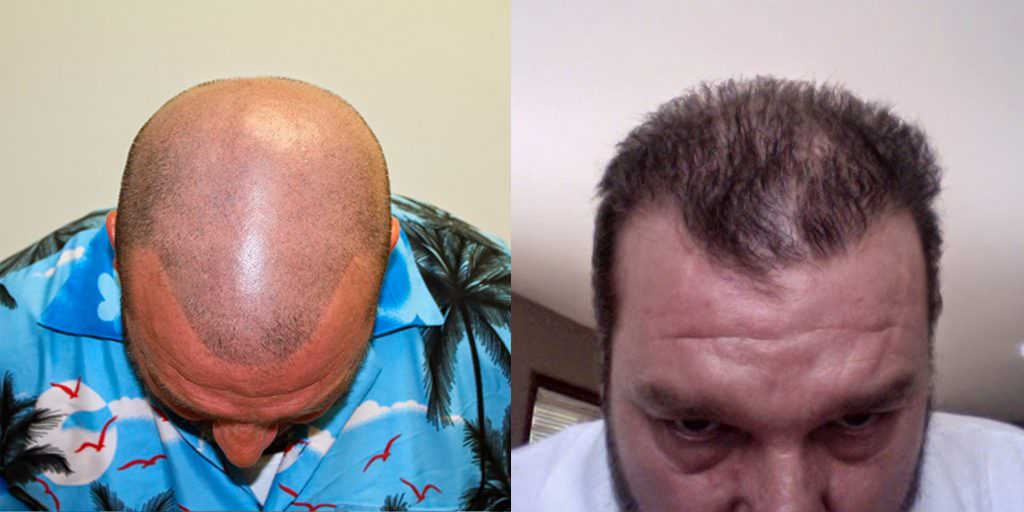 Full Head Tattoo Turned Into Full Head Of Hair Before And Afters Difficult Cases Hairline Tattoo/Micro Pigmentation 