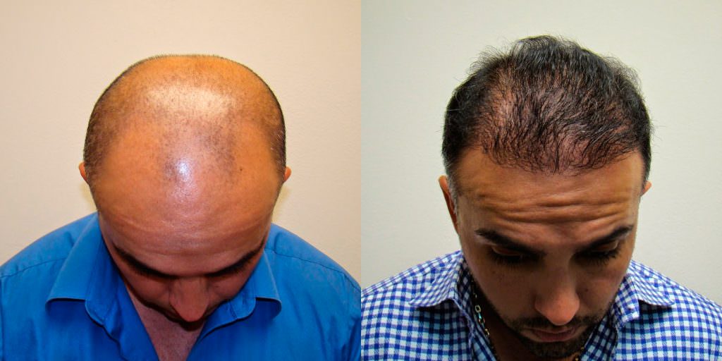 Reverse Hair Loss With A Customized Hair Transplant Before And Afters Difficult Cases Hairline 