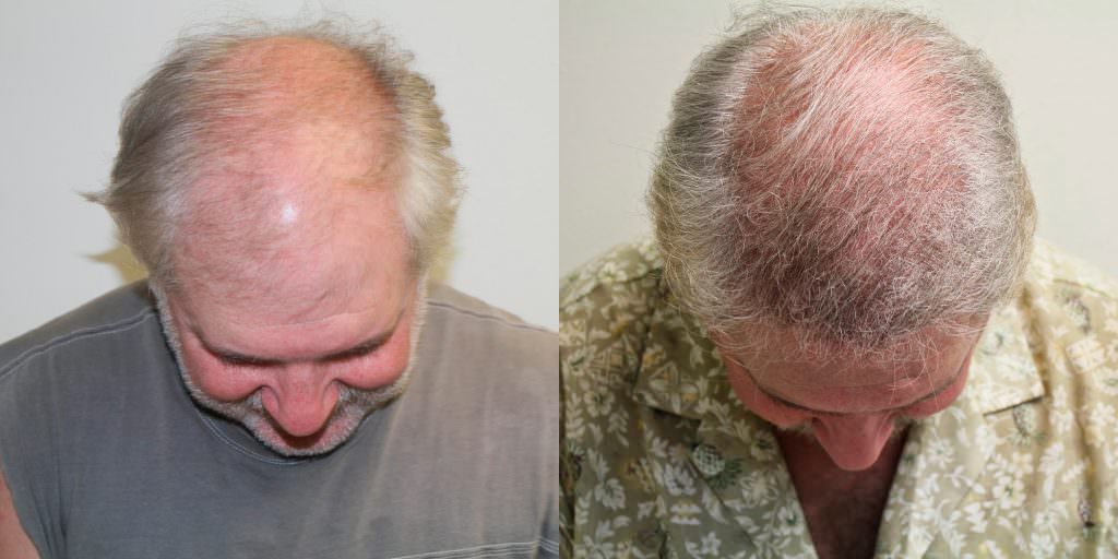 Hair Transplant Before And After Importance Before And Afters Crown Difficult Cases Healing/Growth Process 