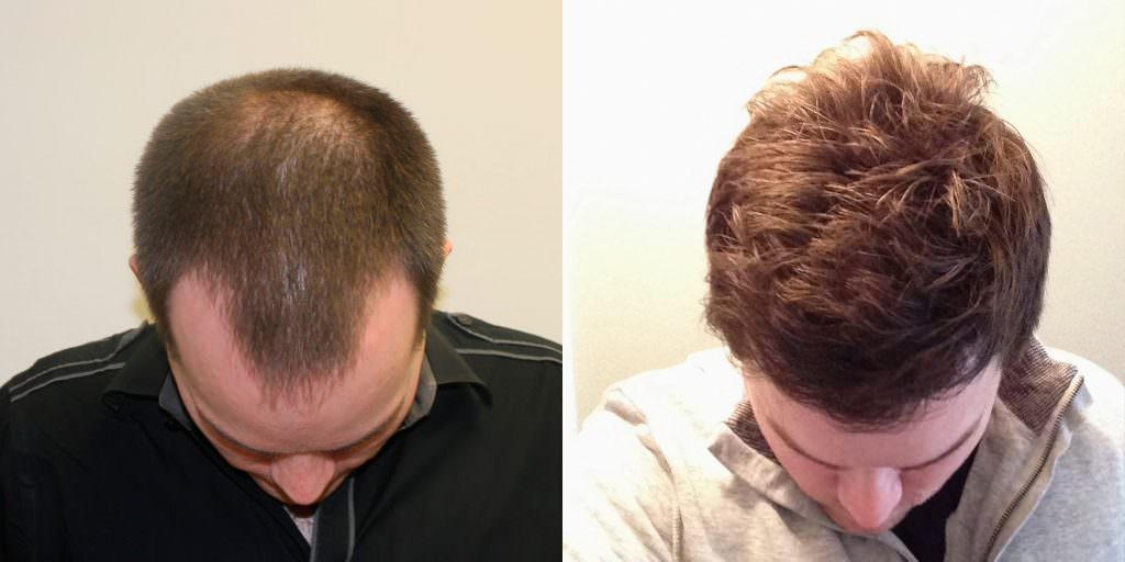 Premature Hair Loss Correction Before And Afters Crown Hairline Healing/Growth Process 