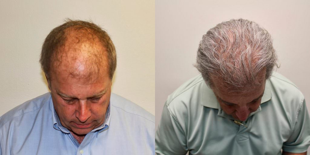 From Shaved Head To Slicked Back Hair After 1 Hair Transplant Before And Afters Crown Hairline 