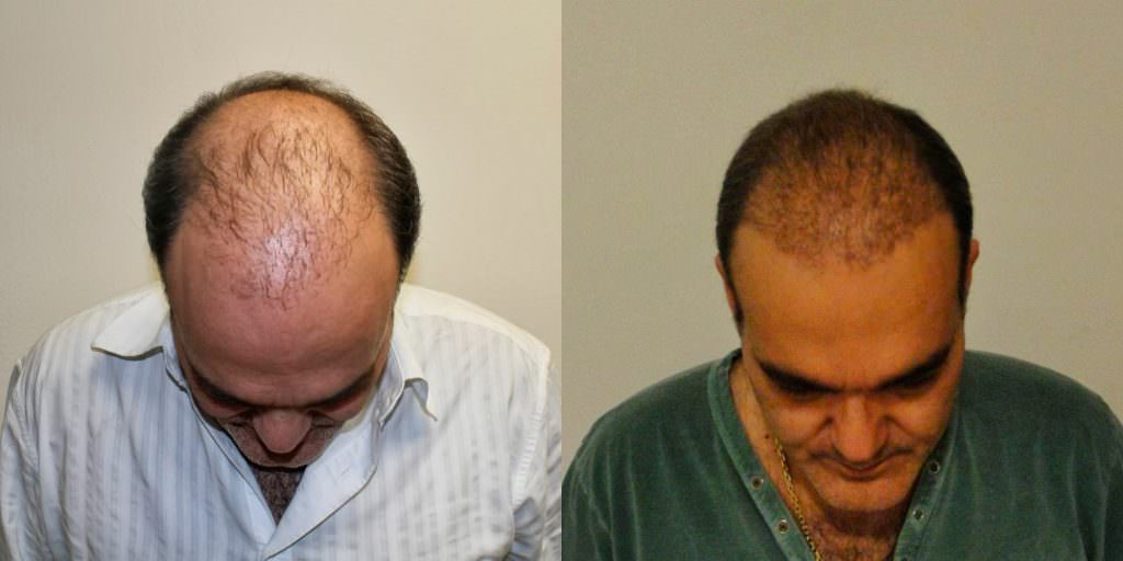 This Is The Most Effective Way To Restore Your Hair Before And Afters Crown Difficult Cases Hair Transplant Industry Exposed Hairline Healing/Growth Process MaxHarvest Plus™ Procedures 