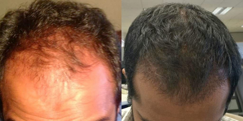 Hairline-Focused Hair Transplant Procedure Before And Afters Hairline Healing/Growth Process 