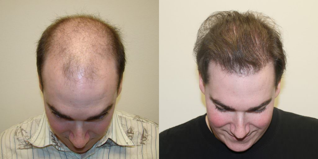 1 Hair Transplant, 10 Years Younger Before And Afters Difficult Cases Hairline 