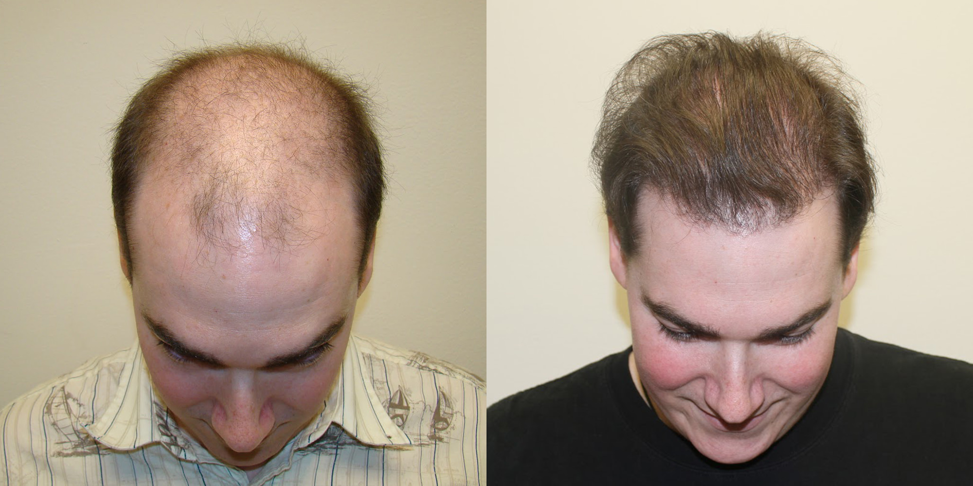 1 Hair Transplant, 10 Years Younger.