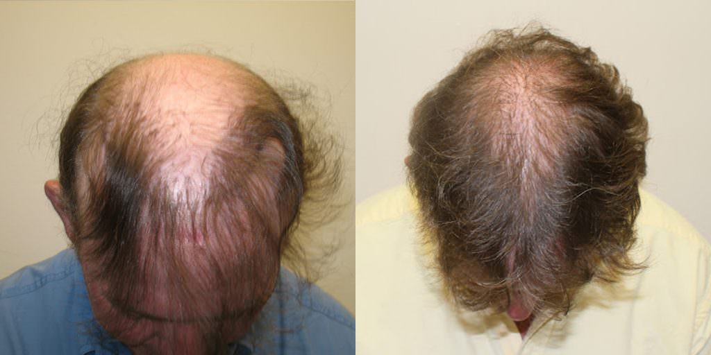 Dr. Bolton Greatly Improves Botched Hair Transplant Before And Afters Crown Difficult Cases Hair Transplant Industry Exposed 