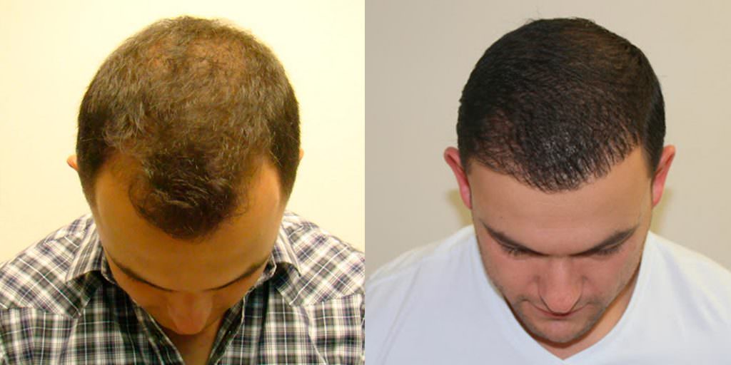 Worried About A Scar After A Hair Transplant? Before And Afters Hairline Suture Line/Scar 