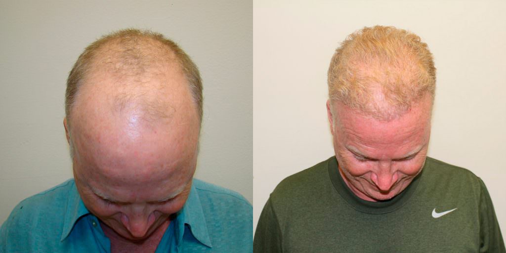 Complete Hair Loss Transformation After Just 1 MaxHarvest Plus™ Procedure Before And Afters Crown Difficult Cases Hairline Healing/Growth Process MaxHarvest Plus™ Procedures 