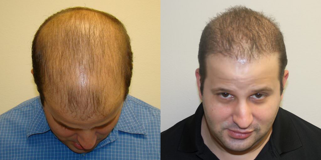 Completely Bald Patient Dramatically Changes His Appearance Before And Afters Difficult Cases 