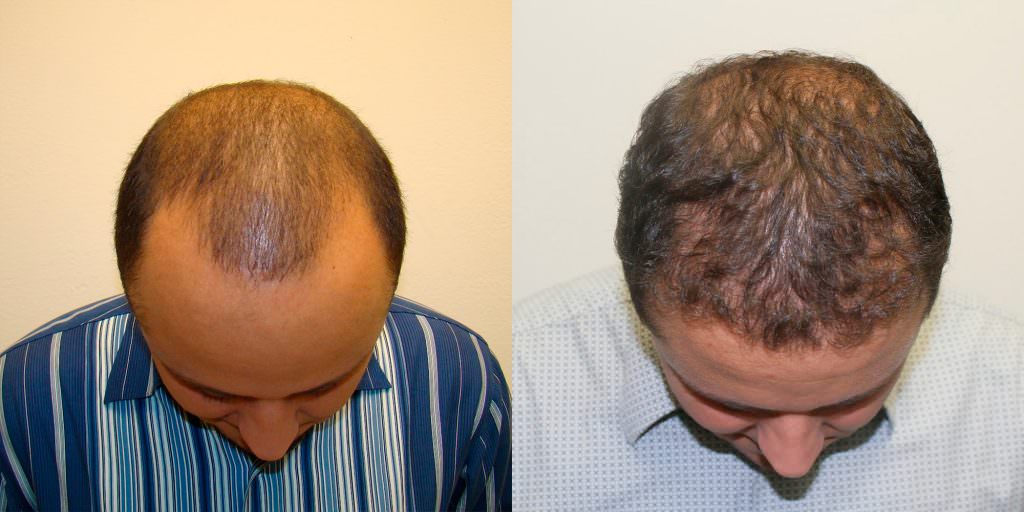 Another Great Hair Transplant Result To Fix Premature Balding Before And Afters Hairline 