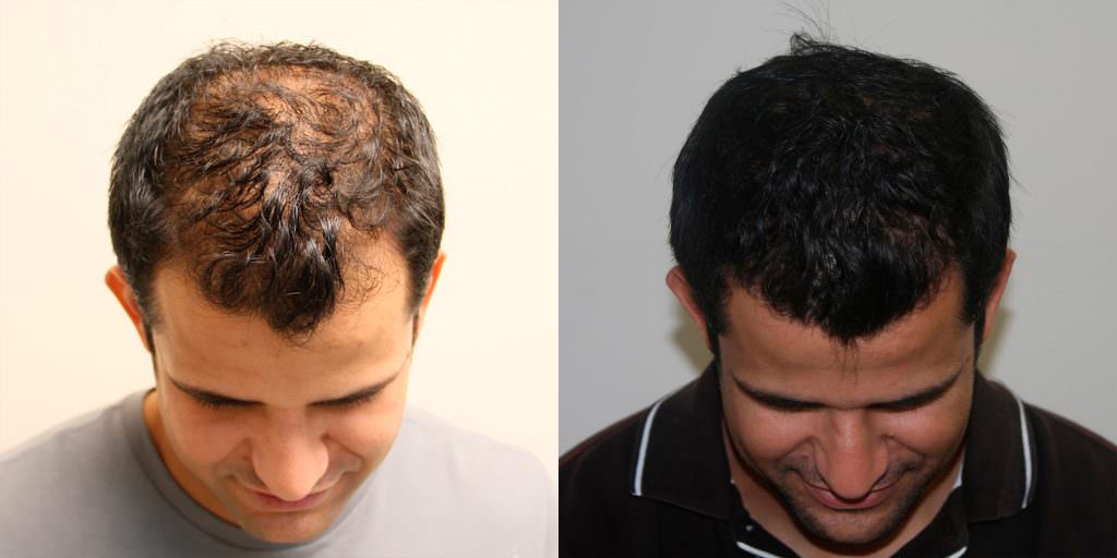 Full And Thick Density, 1 Procedure Hair Transplant Result Before And Afters Crown Healing/Growth Process 