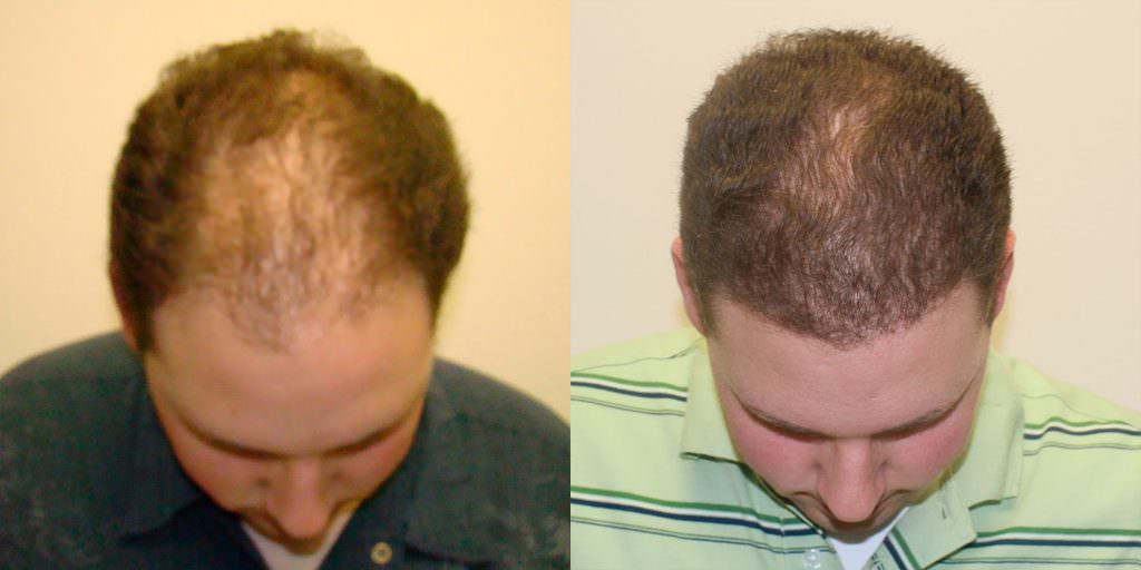 Twenty Year Old's Hair Transformation To Fix Hairline Before And Afters Difficult Cases Hairline