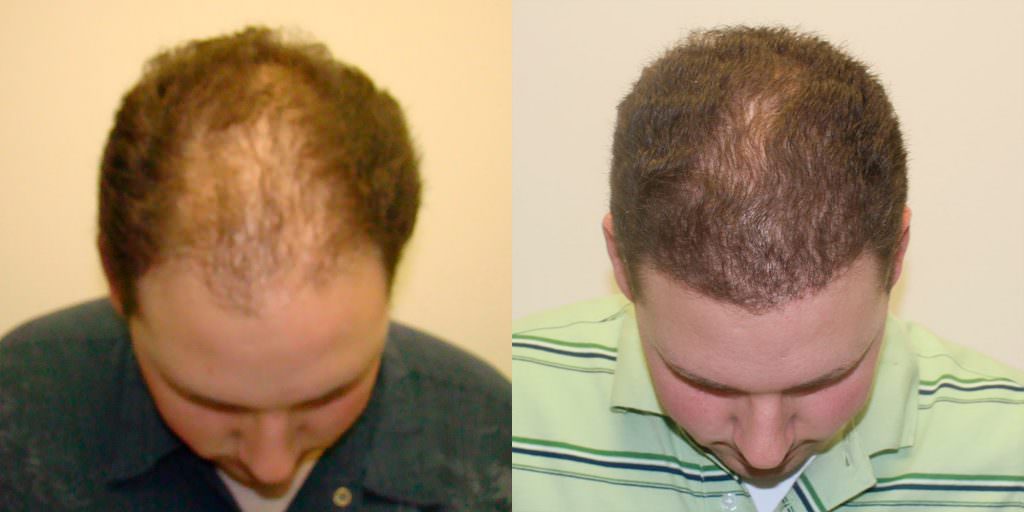 Twenty Year Old's Hair Transformation To Fix Hairline Before And Afters Difficult Cases Hairline 