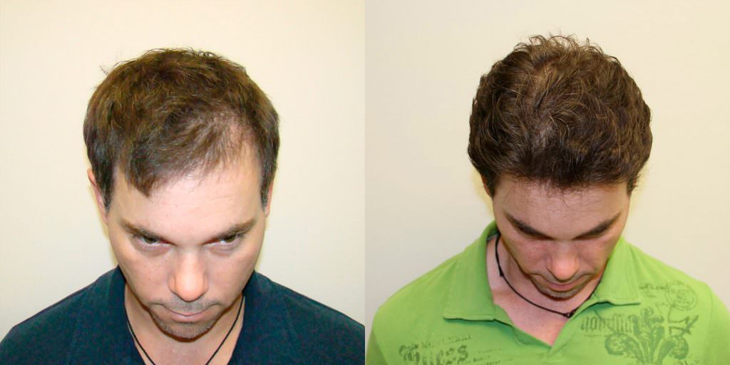 Actor Wants To Stabilize Hair Loss And Improve His Appearance With A Proven Hair Transplant Method Before And Afters 